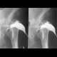 Hip replacement, osteomyelitis, fistula of hip joint: X-ray - Plain radiograph